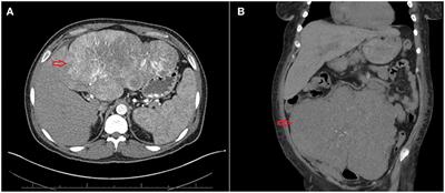 Non-islet Cell Hypoglycemia: Case Series and Review of the Literature